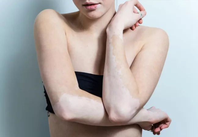 Transplante de Vitiligo: um avanço no tratamento para recuperar a cor da pele