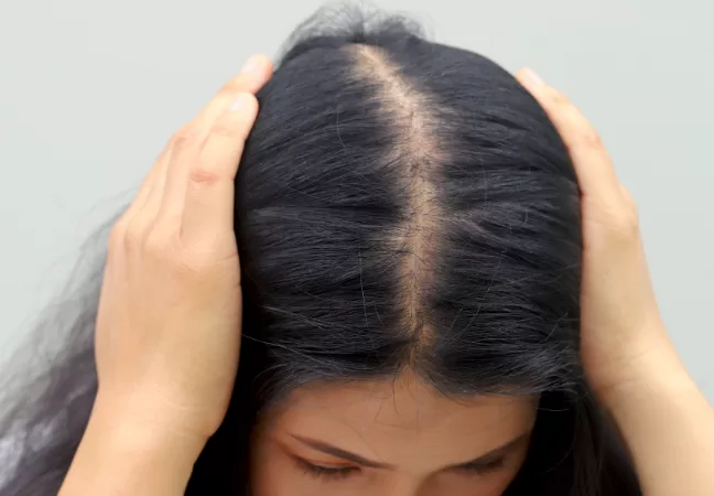 Entenda quando a queda de cabelo é anormal, quais são as principais causas e tipos de queda capilar e como tratar de forma eficaz com acompanhamento dermatológico.