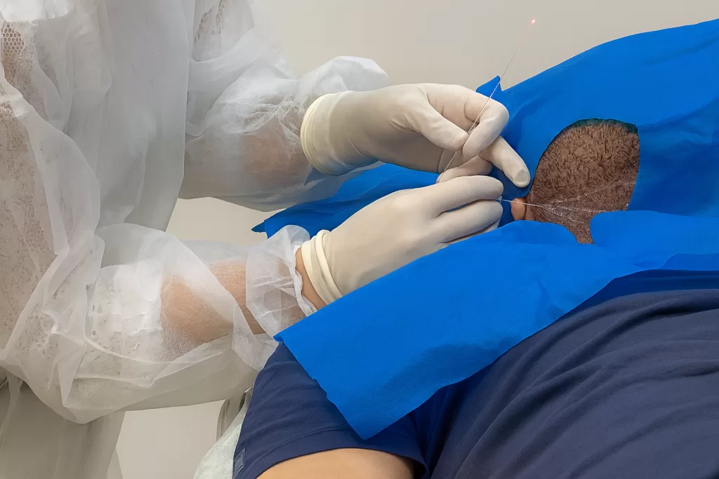 Flacidez de Papada: causas e os melhores tratamentos para redefinir o contorno facial