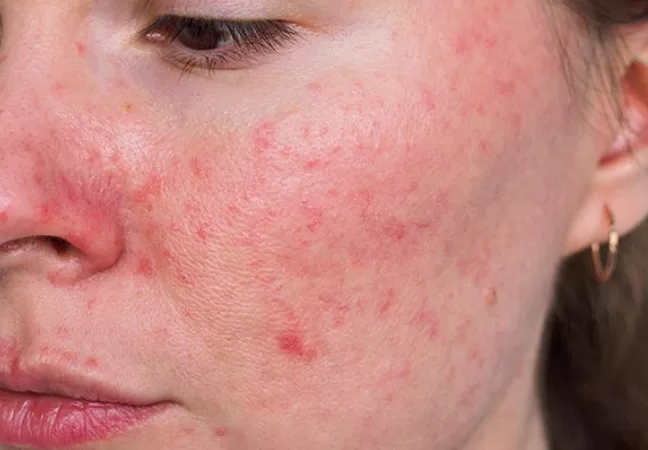 Rosácea: o que é, por que surge e como o tratamento com lasers combinados pode transformar a pele 5 Rosácea: o que é, por que surge e como o tratamento com lasers combinados pode transformar a pele