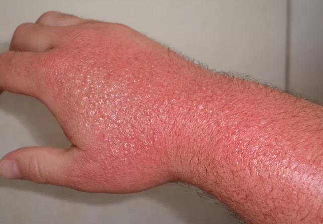 Fitofotodermatose: a queimadura causada pelo limão 4 Entenda o que é fitofotodermatose (a famosa queimadura de limão), por que acontece, sinais e sintomas, tratamento e como prevenir manchas e bolhas na pele.