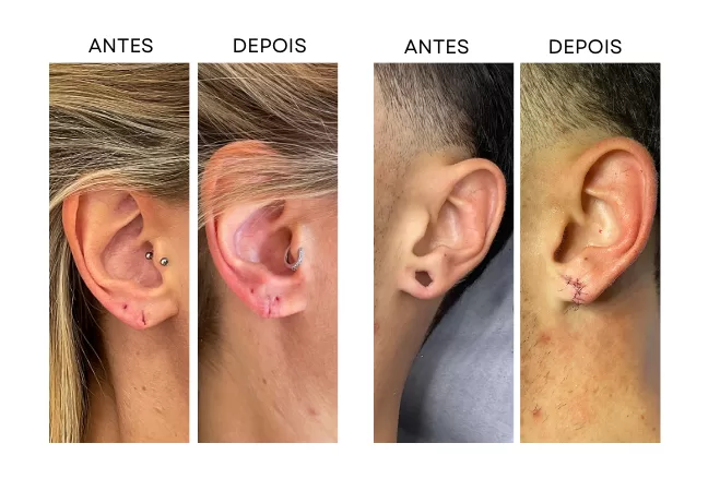 Lobuloplastia: tudo o que você precisa saber sobre a correção do “rasgo” na orelha" 1 Lobuloplastia: tudo o que você precisa saber sobre a correção do “rasgo” na orelha"