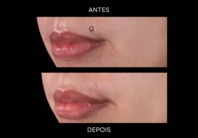 Quando remover uma pinta? 5 Entenda quando remover uma pinta, o que são nevos melanocíticos, principais indicações, avaliação dermatológica, técnicas de remoção, cicatriz e cuidados no pós-operatório.