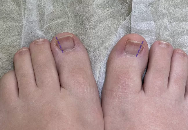 Cantoplastia: a cirurgia definitiva para unha encravada 7 Cantoplastia: a cirurgia definitiva para unha encravada