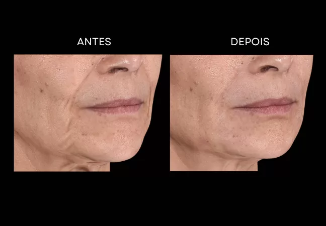 Preenchimento de Bigode Chinês: quando fazer e como evitar aspecto artificial 2 Preenchimento de Bigode Chinês: quando fazer e como evitar aspecto artificial