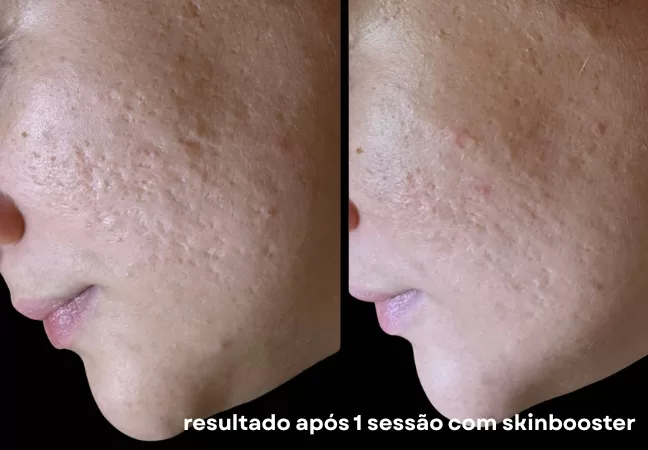 Blog - Dermatologista em Pinheiros 2 Tratamento de cicatriz de acne: como melhorar textura, relevo e qualidade da pele