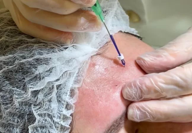 Blog - Dermatologista em Pinheiros 1 Fio de PDO Multifilamentado para Rugas Profundas: Como Tratar Vincos Marcados Sem Volumizar o Rosto