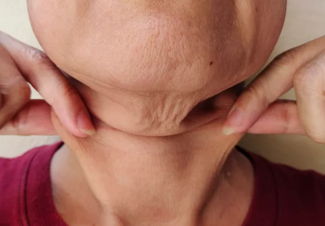 Blog - Dermatologista em Pinheiros 3 Efeitos Colaterais Após o Uso do Mounjaro® (Tirzepatida): Queda de Cabelo, Flacidez e Alterações na Pele