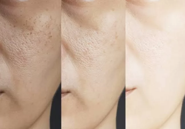 Blog - Dermatologista em Pinheiros 1 Tratamento do melasma: como a associação entre lasers, medicamentos e protocolos personalizados pode controlar as manchas