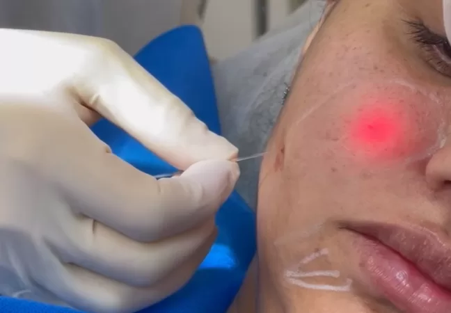 Blog - Dermatologista em Pinheiros 1 Endolaser: como funciona o tratamento para gordura localizada e flacidez da pele?