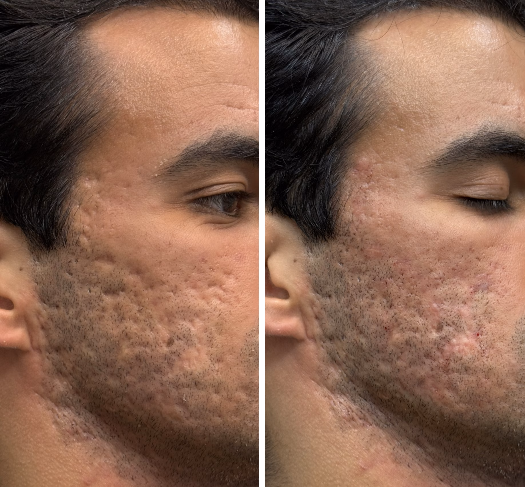 Blog - Dermatologista em Pinheiros 2 Tratamento de cicatrizes de acne: como o ácido hialurônico e o laser podem melhorar a textura da pele